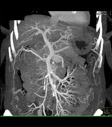 Cirrhosis - CTisus CT Scan