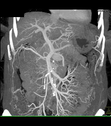 Cirrhosis - CTisus CT Scan