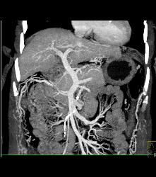 Cirrhosis - CTisus CT Scan