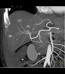 Multifocal Hepatocellular Carcinoma (Hepatoma) in Cirrhotic Liver - CTisus CT Scan