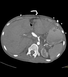 Hepatic Artery Aneurysm S/p Liver Transplant - CTisus CT Scan