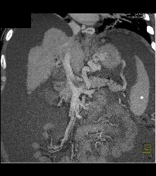 Cirrhosis With Varices With Portal Portal Vein Thrombosis (PVT) - CTisus CT Scan