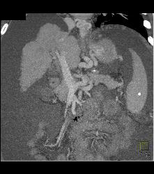 Cirrhosis With Varices With Portal Portal Vein Thrombosis (PVT) - CTisus CT Scan