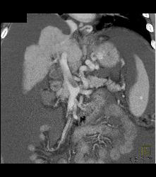 Cirrhosis With Varices With Portal Portal Vein Thrombosis (PVT) - CTisus CT Scan