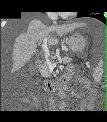 Cirrhosis With Varices With Portal Portal Vein Thrombosis (PVT) - CTisus CT Scan