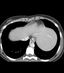 Cirrhosis With Varices and Ulcerative Colitis - CTisus CT Scan