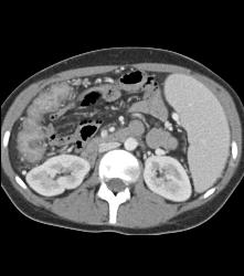 Cirrhosis With Varices and Ulcerative Colitis - CTisus CT Scan