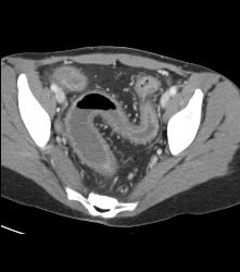 Cirrhosis With Varices and Ulcerative Colitis - CTisus CT Scan