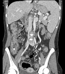 Cirrhosis With Varices and Ulcerative Colitis - CTisus CT Scan