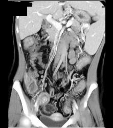 Cirrhosis With Varices and Ulcerative Colitis - CTisus CT Scan