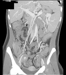 Cirrhosis With Varices and Ulcerative Colitis - CTisus CT Scan