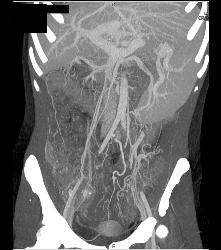 Cirrhosis With Varices and Ulcerative Colitis - CTisus CT Scan