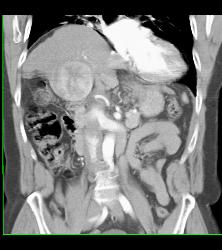 Hepatocellular Carcinoma (Hepatoma) - CTisus CT Scan