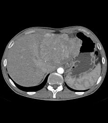 Fibrolamellar Hepatocellular Carcinoma (Hepatoma) - Multiple Visualizations - CTisus CT Scan