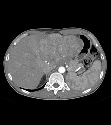 Fibrolamellar Hepatocellular Carcinoma (Hepatoma) - Multiple Visualizations - CTisus CT Scan