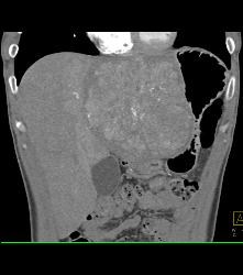 Fibrolamellar Hepatocellular Carcinoma (Hepatoma) - Multiple Visualizations - CTisus CT Scan