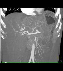 Fibrolamellar Hepatocellular Carcinoma (Hepatoma) - Multiple Visualizations - CTisus CT Scan