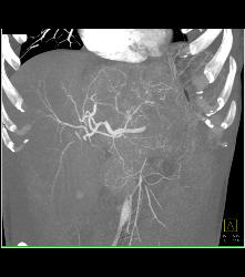 Fibrolamellar Hepatocellular Carcinoma (Hepatoma) - Multiple Visualizations - CTisus CT Scan