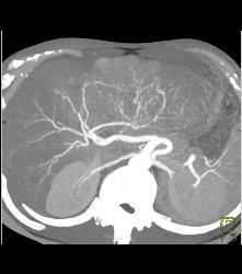 Fibrolamellar Hepatocellular Carcinoma (Hepatoma) - Multiple Visualizations - CTisus CT Scan