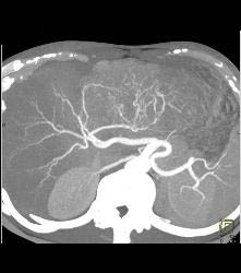 Fibrolamellar Hepatocellular Carcinoma (Hepatoma) - Multiple Visualizations - CTisus CT Scan