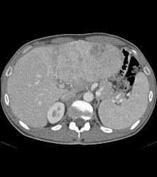 Fibrolamellar Hepatocellular Carcinoma (Hepatoma) - Multiple Visualizations - CTisus CT Scan