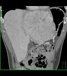 Fibrolamellar Hepatocellular Carcinoma (Hepatoma) - Multiple Visualizations - CTisus CT Scan