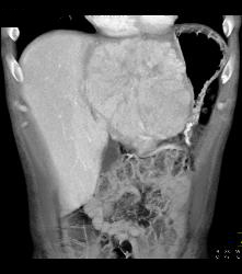 Fibrolamellar Hepatocellular Carcinoma (Hepatoma) - Multiple Visualizations - CTisus CT Scan