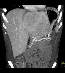 Fibrolamellar Hepatocellular Carcinoma (Hepatoma) - Multiple Visualizations - CTisus CT Scan