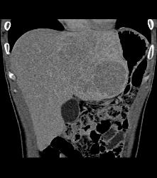 Fibrolamellar Hepatocellular Carcinoma (Hepatoma) - Multiple Visualizations - CTisus CT Scan