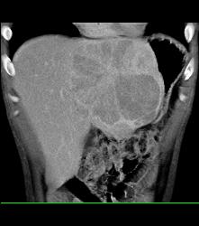 Fibrolamellar Hepatocellular Carcinoma (Hepatoma) - Multiple Visualizations - CTisus CT Scan