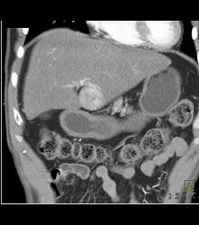 Hepatocellular Carcinoma (Hepatoma) - CTisus CT Scan