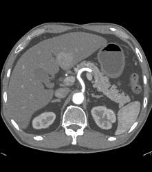 Hepatocellular Carcinoma (Hepatoma) - CTisus CT Scan