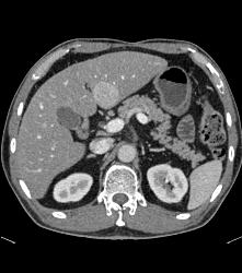 Hepatocellular Carcinoma (Hepatoma) - CTisus CT Scan