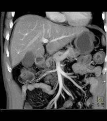 Hepatocellular Carcinoma (Hepatoma) - CTisus CT Scan