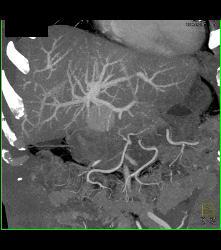 Hepatocellular Carcinoma (Hepatoma) - CTisus CT Scan