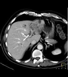 Cholangiocarcinoma - CTisus CT Scan