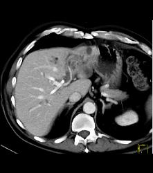 Cholangiocarcinoma - CTisus CT Scan