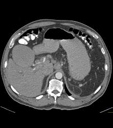 Common Bile Duct (CBD) Tumor With Nodes - CTisus CT Scan