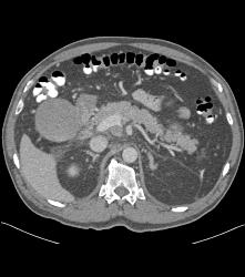 Common Bile Duct (CBD) Tumor With Nodes - CTisus CT Scan