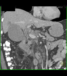 Common Bile Duct (CBD) Tumor With Nodes - CTisus CT Scan