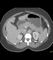 Perihepatic Fluid - CTisus CT Scan