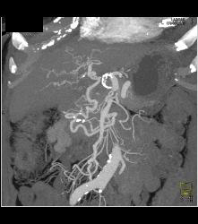 Cirrhosis With Varices and Collaterals - CTisus CT Scan