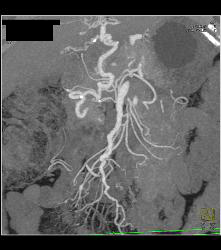 Cirrhosis With Varices and Collaterals - CTisus CT Scan