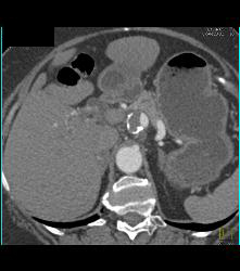 Celiac Artery Aneurysm - CTisus CT Scan