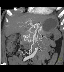 Celiac Artery Aneurysm - CTisus CT Scan