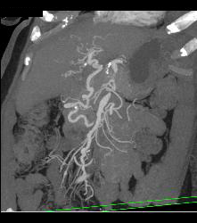 Celiac Artery Aneurysm - CTisus CT Scan