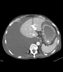 Cirrhosis - CTisus CT Scan