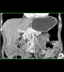 Hepatocellular Carcinoma (Hepatoma) - CTisus CT Scan