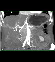 Hepatocellular Carcinoma (Hepatoma) - CTisus CT Scan