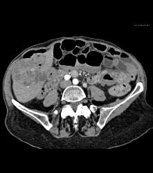 Hepatocellular Carcinoma (Hepatoma) - Liver Case Studies - CTisus CT ...